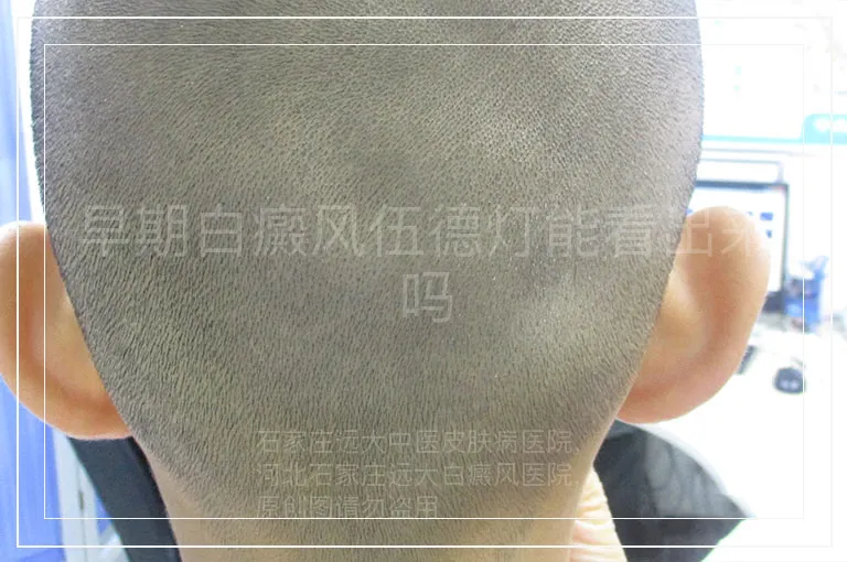 早期白癜风伍德灯能看出来吗
