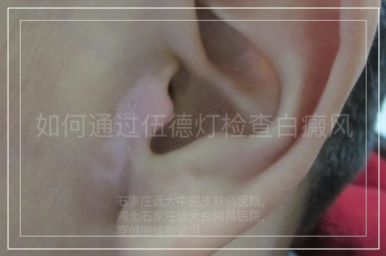 如何通过伍德灯检查白癜风