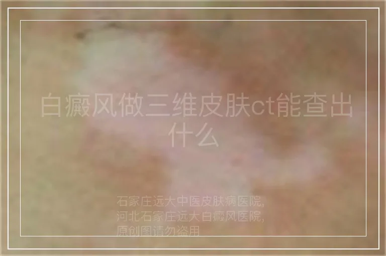白癜风做三维皮肤ct能查出什么