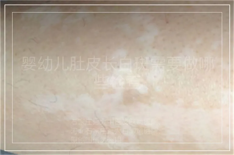 婴幼儿肚皮长白斑需要做哪些检查