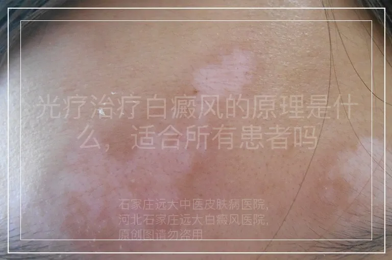 光疗治疗白癜风的原理是什么，适合所有患者吗