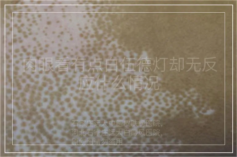 肉眼看有点白伍德灯却无反应什么情况