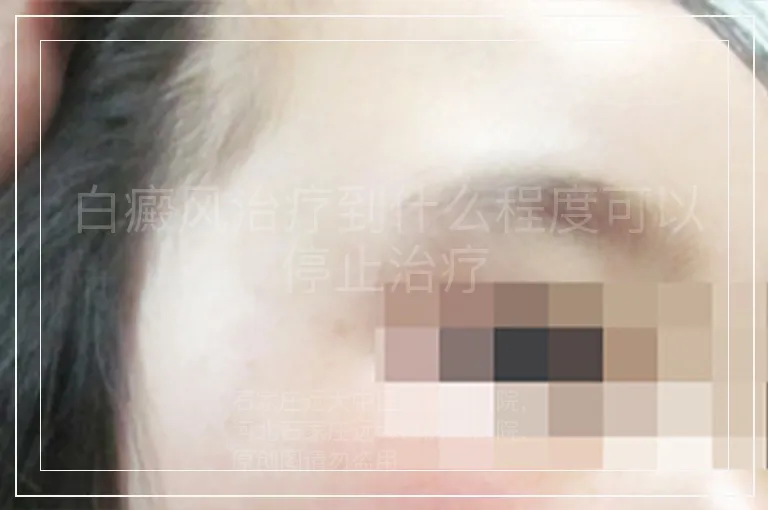 白癜风治疗到什么程度可以停止治疗