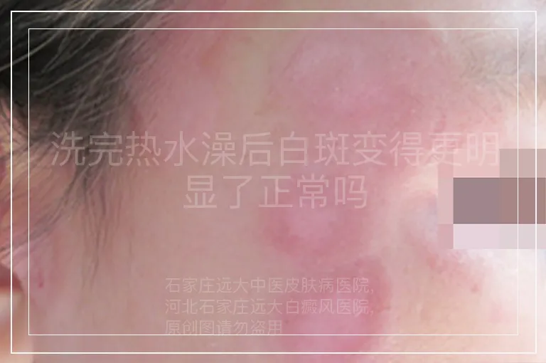 洗完热水澡后白斑变得更明显了正常吗
