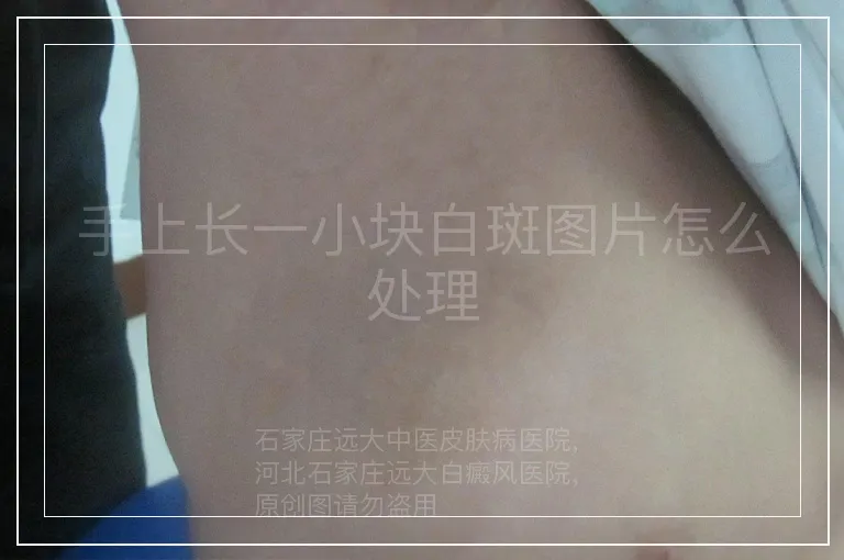 手上长一小块白斑图片怎么处理