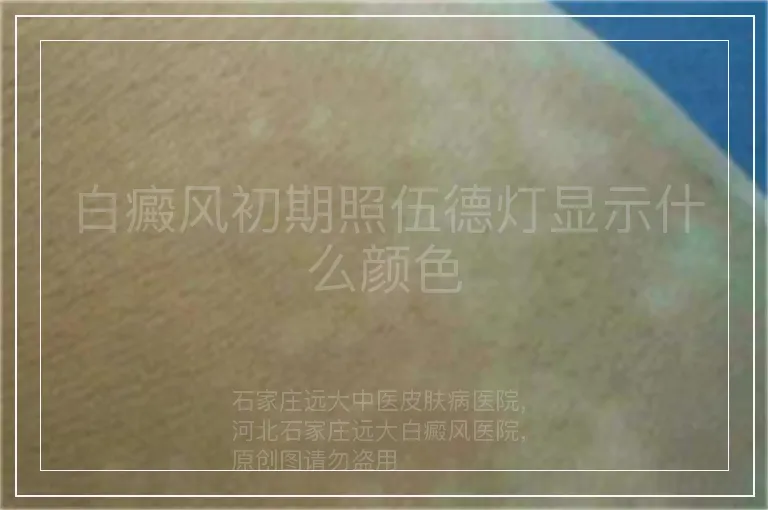 白癜风初期照伍德灯显示什么颜色