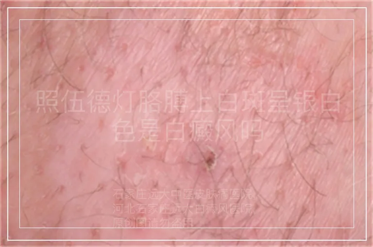 照伍德灯胳膊上白斑呈银白色是白癜风吗