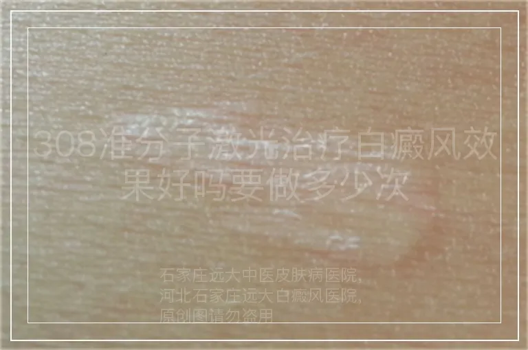 308准分子激光治疗白癜风效果好吗要做多少次