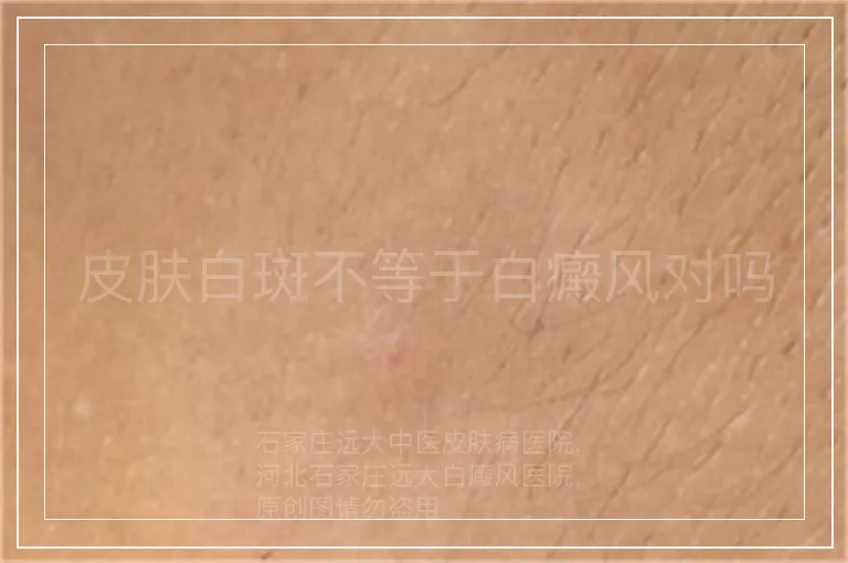 皮肤白斑不等于白癜风对吗