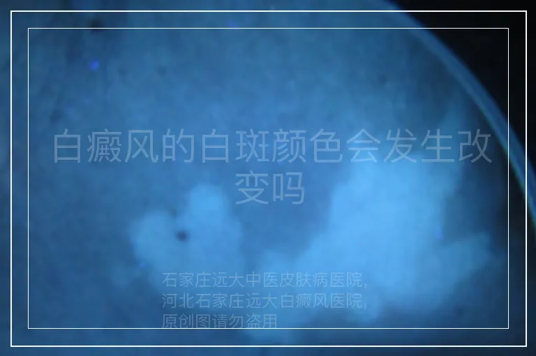 白癜风的白斑颜色会发生改变吗