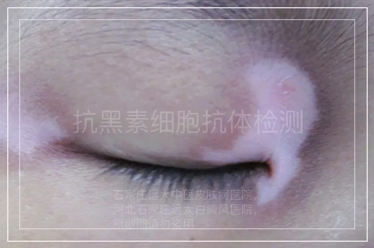 抗黑素细胞抗体检测