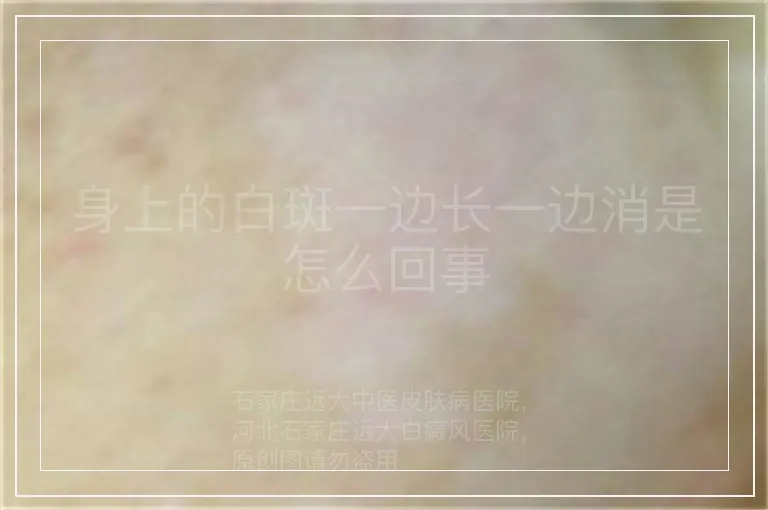 身上的白斑一边长一边消是怎么回事