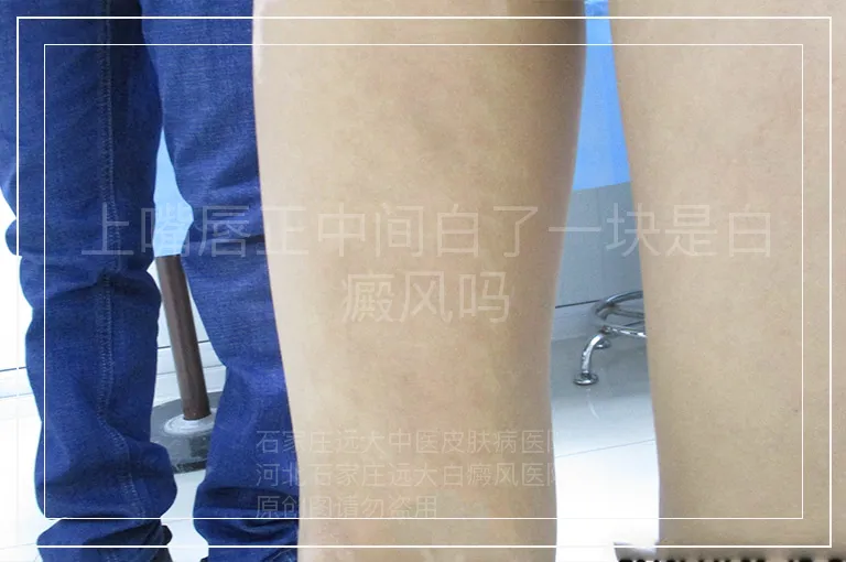 上嘴唇正中间白了一块是白癜风吗