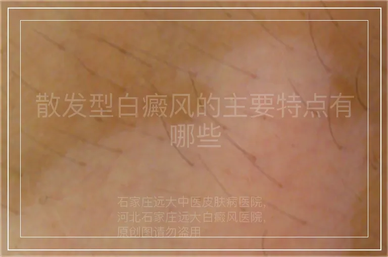 散发型白癜风的主要特点有哪些