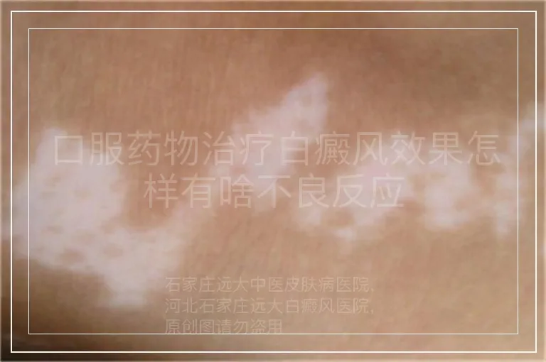 口服药物治疗白癜风效果怎样有啥不良反应
