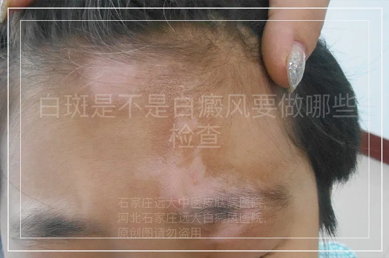 白斑是不是白癜风要做哪些检查