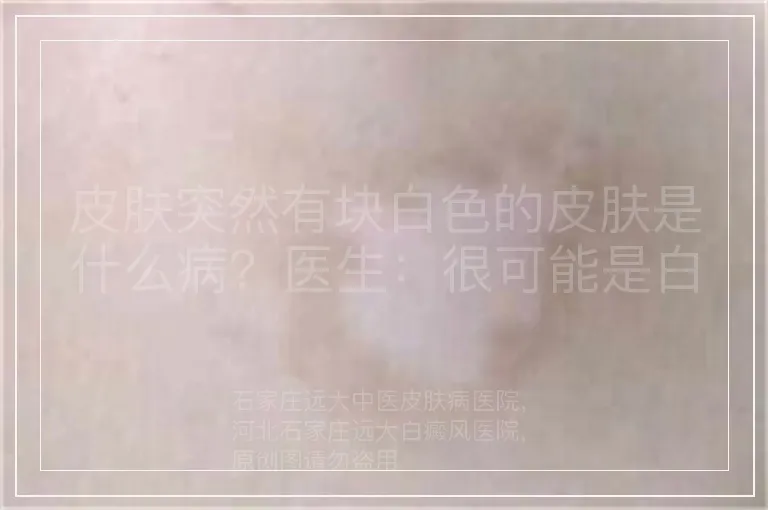 皮肤突然有块白色的皮肤是什么病？医生：很可能是白癜风
