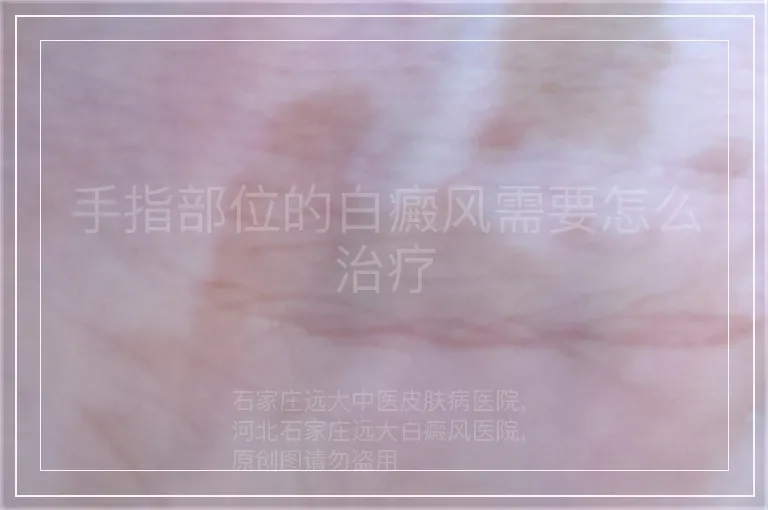 手指部位的白癜风需要怎么治疗