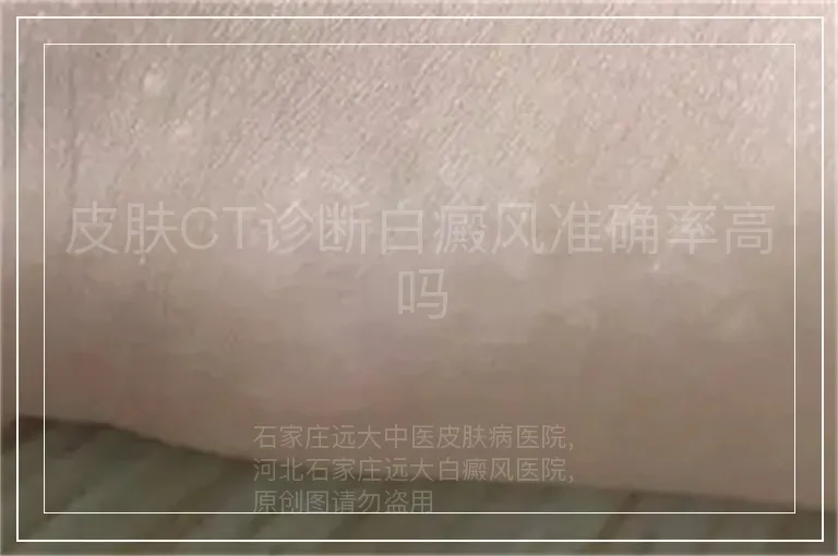 皮肤CT诊断白癜风准确率高吗