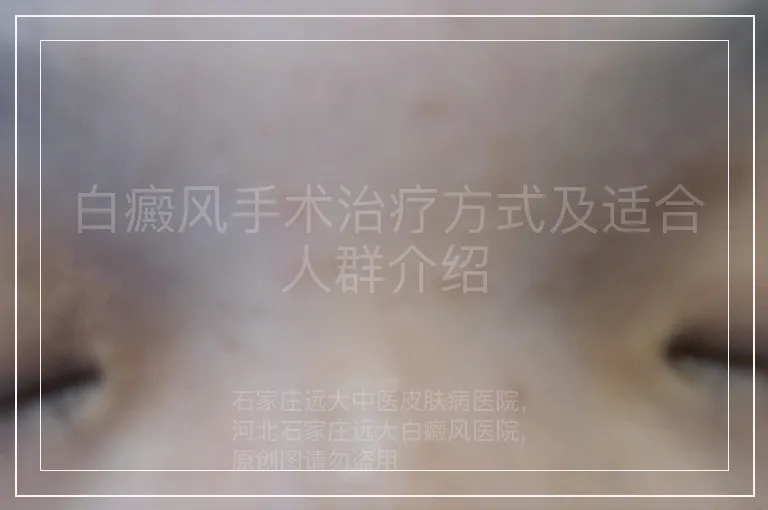 白癜风手术治疗方式及适合人群介绍