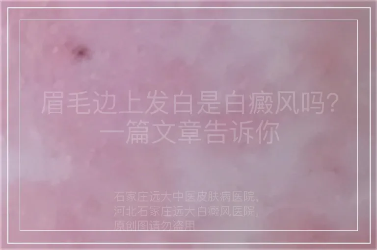 眉毛边上发白是白癜风吗？一篇文章告诉你