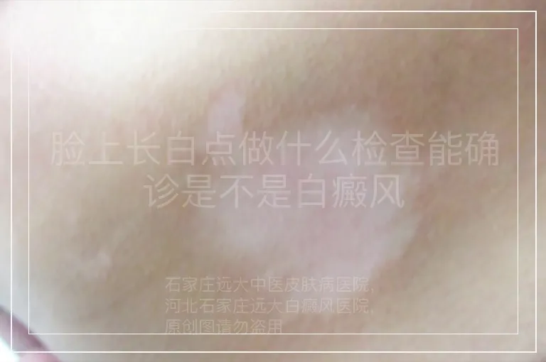 脸上长白点做什么检查能确诊是不是白癜风
