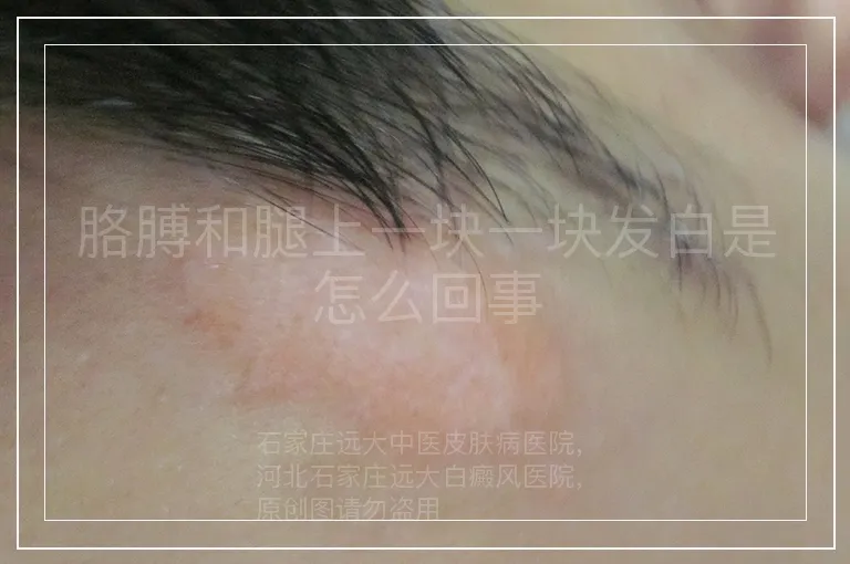 胳膊和腿上一块一块发白是怎么回事