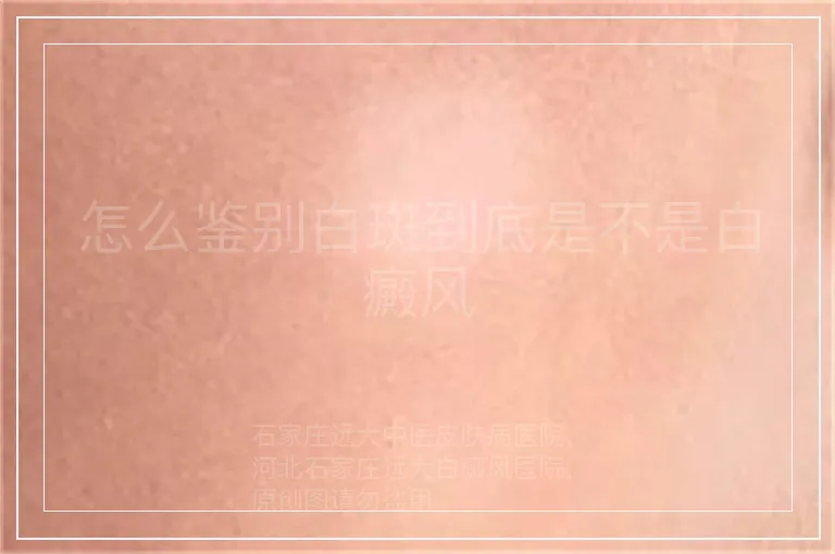 怎么鉴别白斑到底是不是白癜风