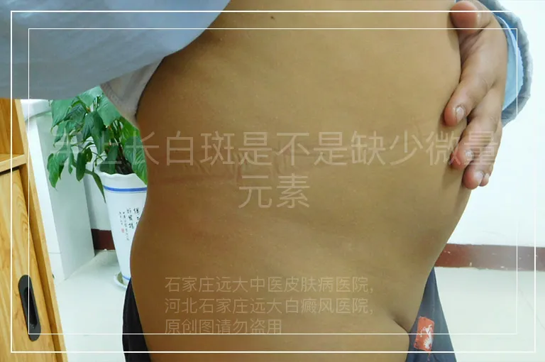 手上长白斑是不是缺少微量元素