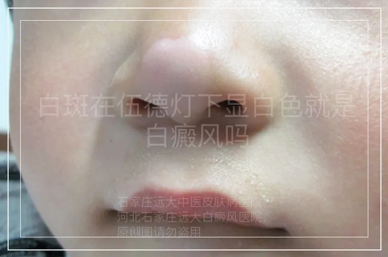 白斑在伍德灯下显白色就是白癜风吗