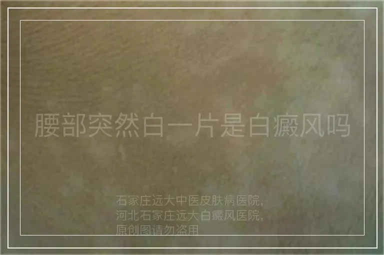 腰部突然白一片是白癜风吗