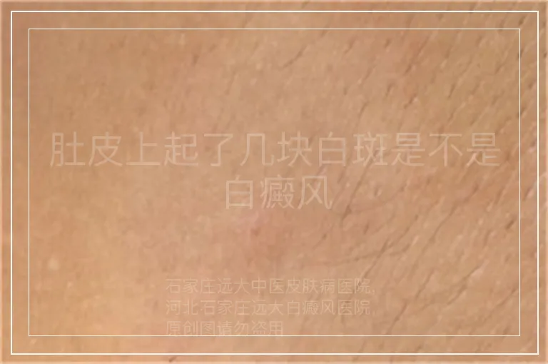 肚皮上起了几块白斑是不是白癜风