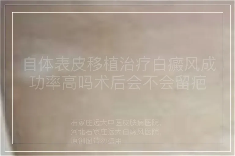 自体表皮移植治疗白癜风成功率高吗术后会不会留疤