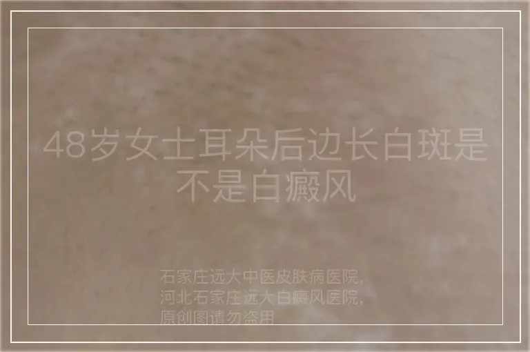 48岁女士耳朵后边长白斑是不是白癜风