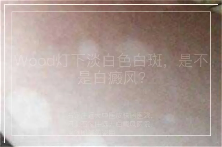 Wood灯下淡白色白斑，是不是白癜风？