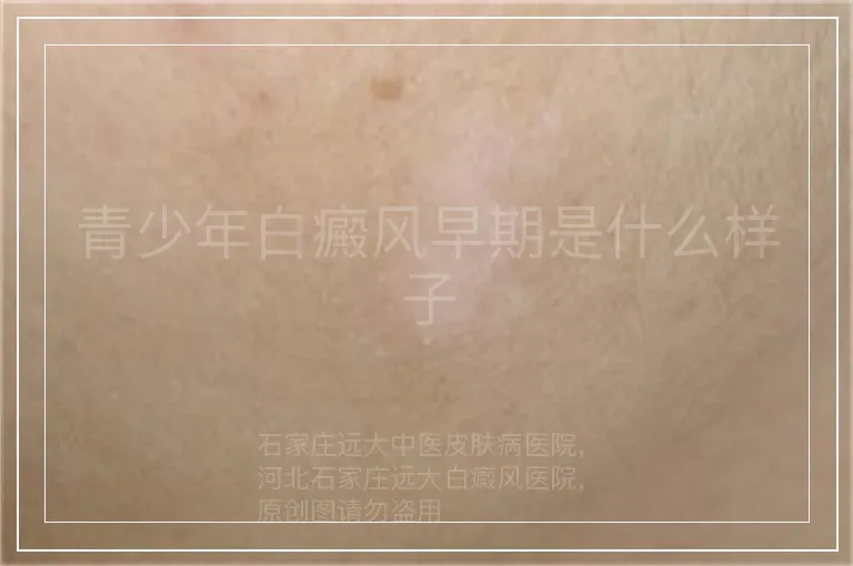 青少年白癜风早期是什么样子