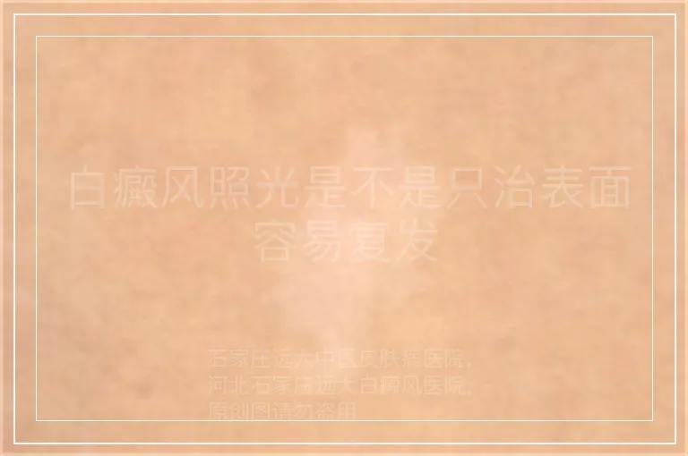 白癜风照光是不是只治表面容易复发