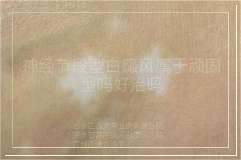 神经节段型白癜风属于顽固型吗好治吗