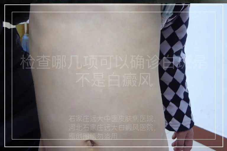 检查哪几项可以确诊白斑是不是白癜风