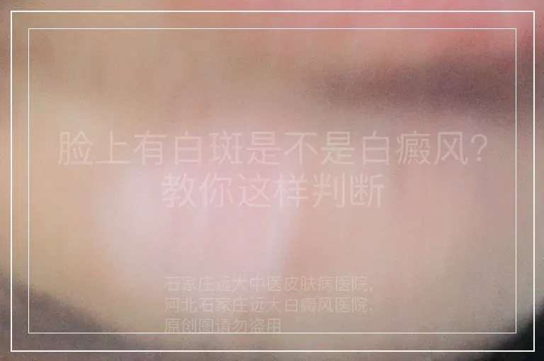脸上有白斑是不是白癜风?教你这样判断