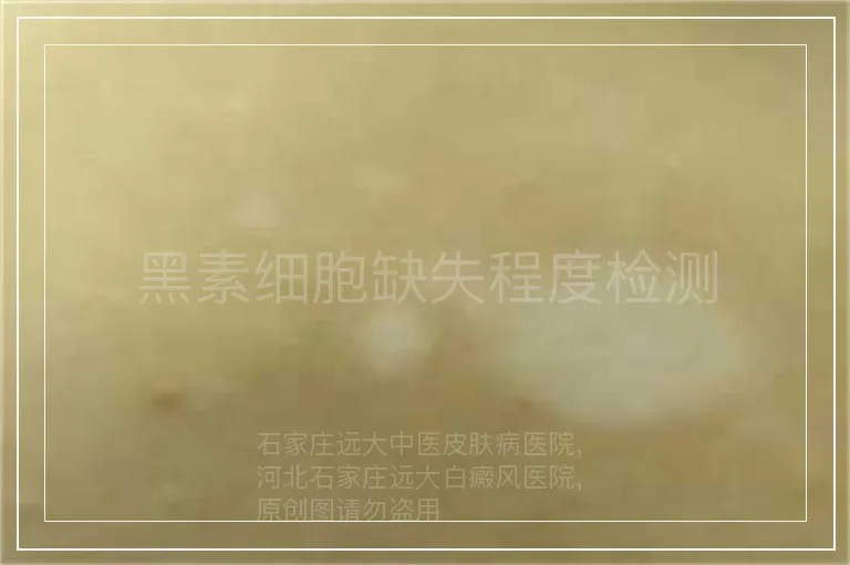 黑素细胞缺失程度检测