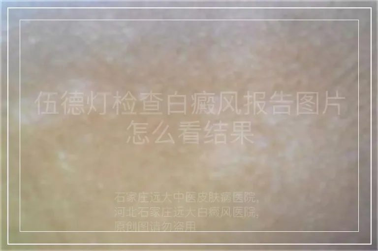 伍德灯检查白癜风报告图片怎么看结果