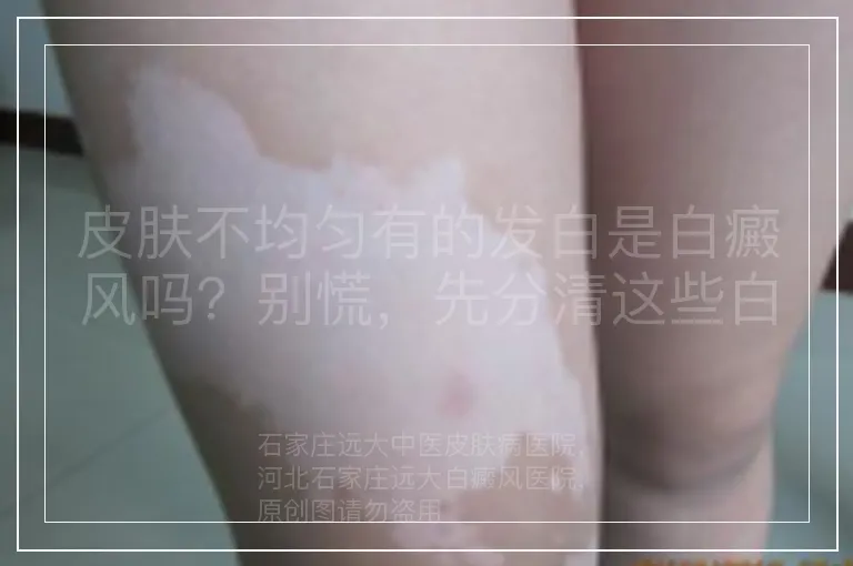 皮肤不均匀有的发白是白癜风吗？别慌，先分清这些白斑