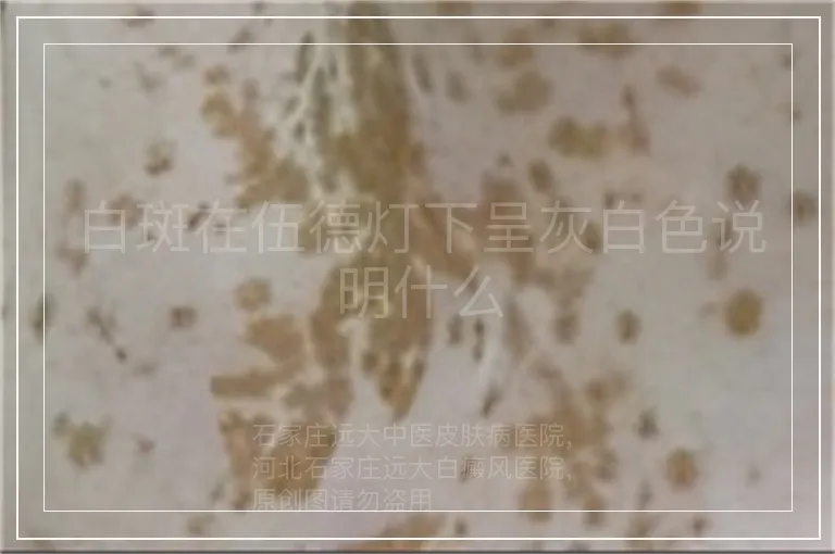 白斑在伍德灯下呈灰白色说明什么