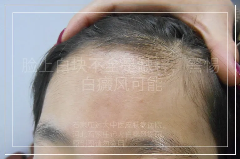 脸上白块不全是缺锌，警惕白癜风可能