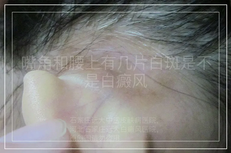 嘴角和腰上有几片白斑是不是白癜风