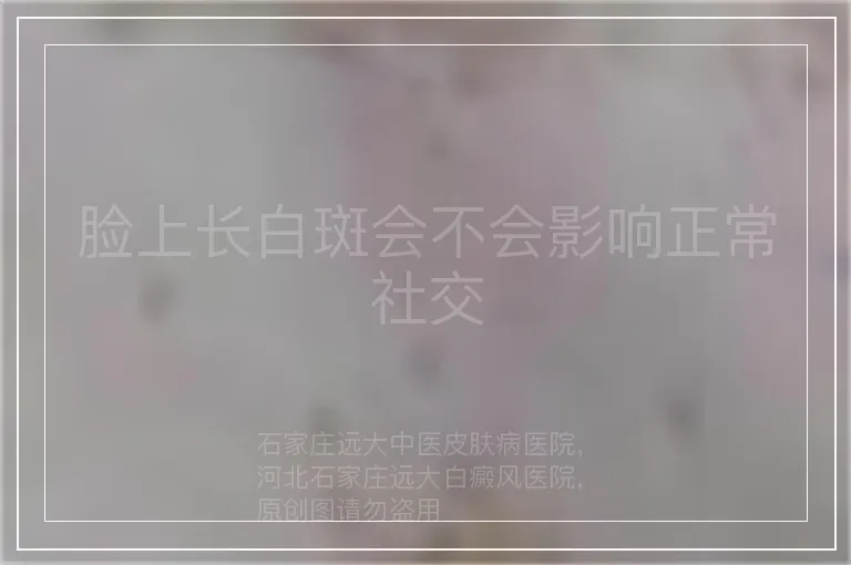 脸上长白斑会不会影响正常社交