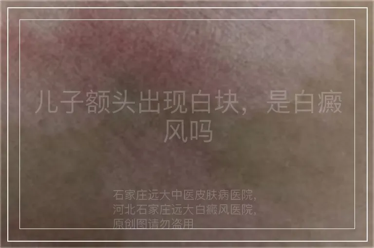 儿子额头出现白块,是白癜风吗
