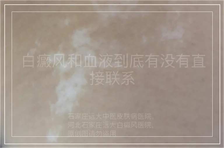 白癜风和血液到底有没有直接联系