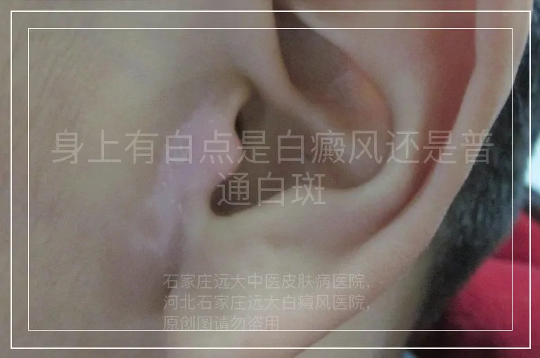 身上有白点是白癜风还是普通白斑